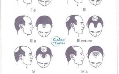 Les différentes phases de la calvitie chez l’homme